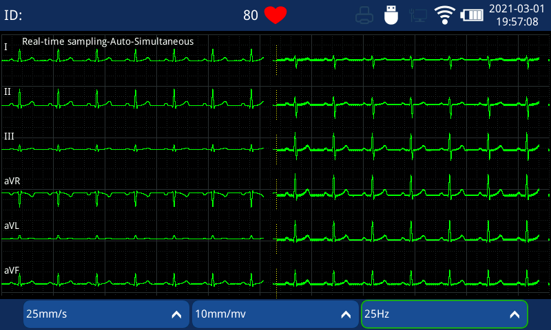 3 channel electrocardiograph machine